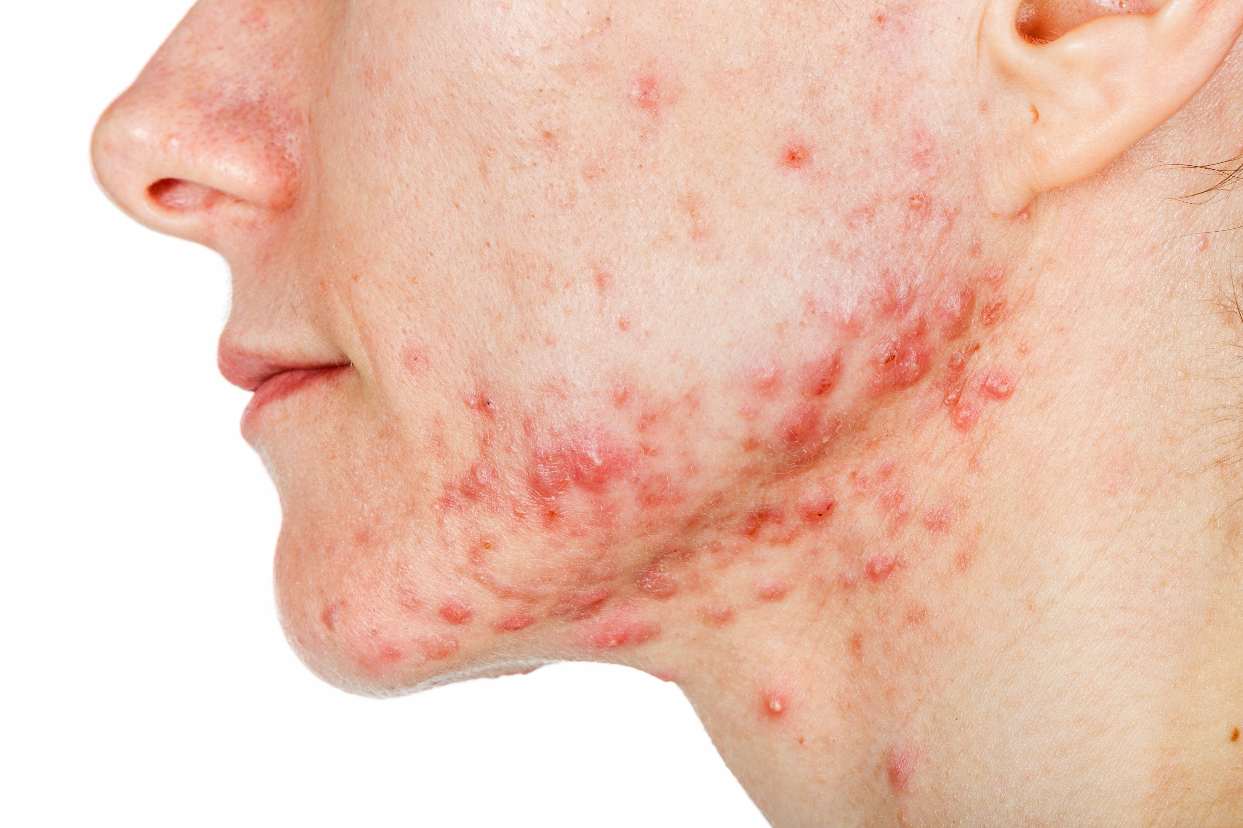 Hormonal Acne